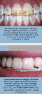 What is Tooth Mousse? How It Can Help Your Teeth: VC Dental